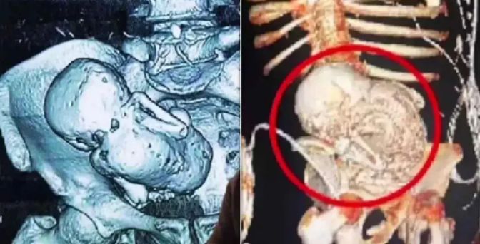 প্রসবের ভয়ে হাসপাতাল ছাড়েন, ৩৬ বছর পর পেটে মিলল ‘পাথর শিশু,